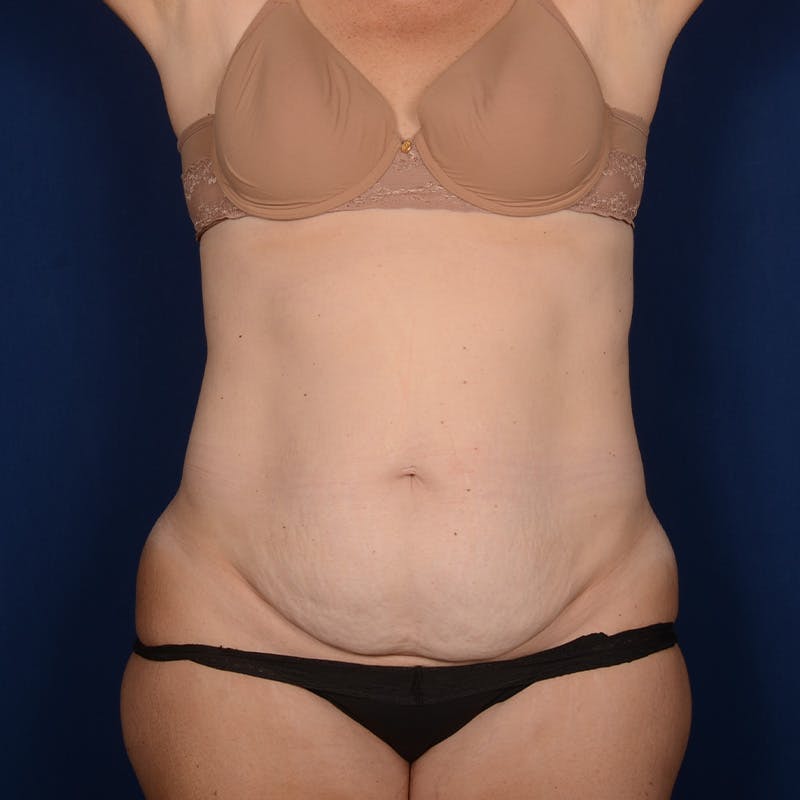 Tummy Tuck Before & After Gallery - Patient 426376 - Image 1