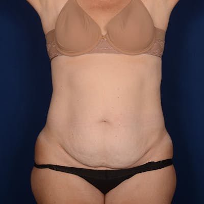 Tummy Tuck Before & After Gallery - Patient 426376 - Image 1
