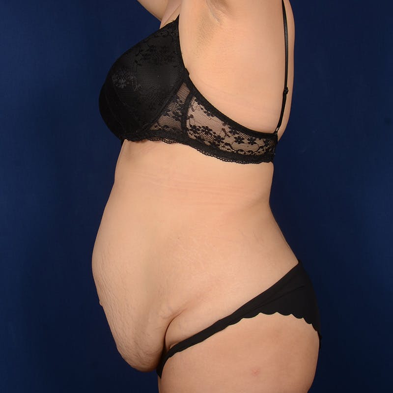 Tummy Tuck Before & After Gallery - Patient 298760 - Image 5