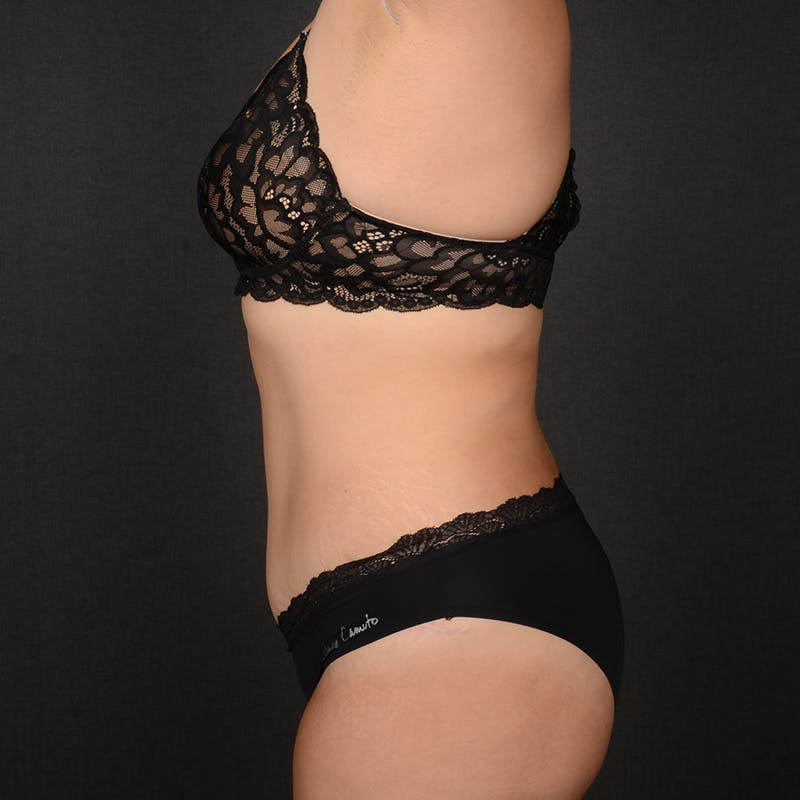 Tummy Tuck Before & After Gallery - Patient 298760 - Image 6