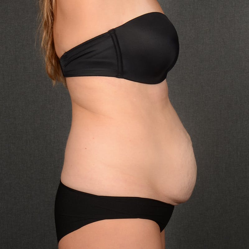 Tummy Tuck Before & After Gallery - Patient 148494 - Image 5