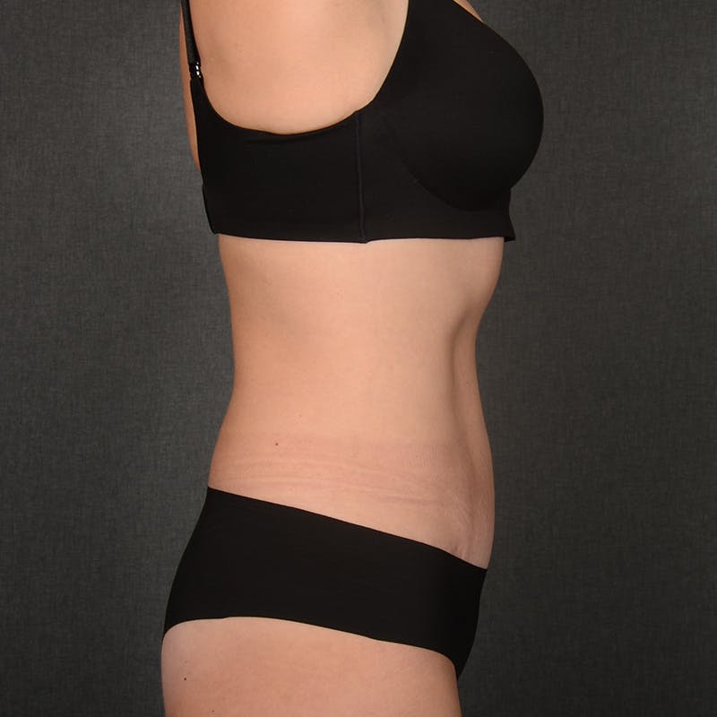 Tummy Tuck Before & After Gallery - Patient 148494 - Image 6