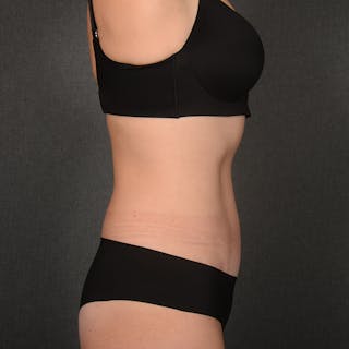 Tummy Tuck Before & After Gallery - Patient 148494 - Image 6