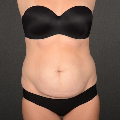 Tummy Tuck Before & After Gallery - Patient 148494 - Image 1