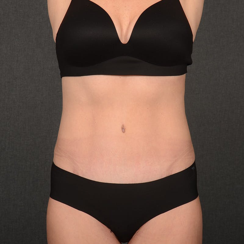 Tummy Tuck Before & After Gallery - Patient 148494 - Image 2