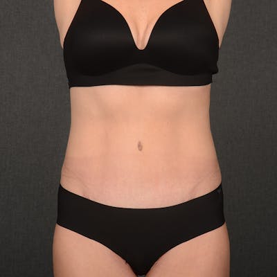 Tummy Tuck Before & After Gallery - Patient 148494 - Image 2