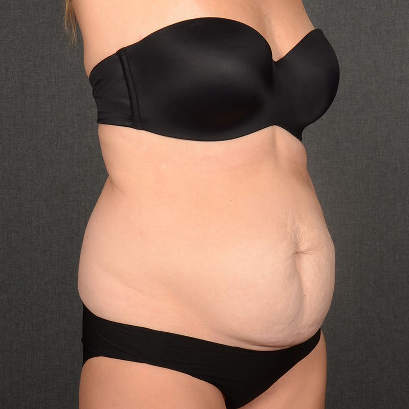 Tummy Tuck Before & After Gallery - Patient 148494 - Image 3