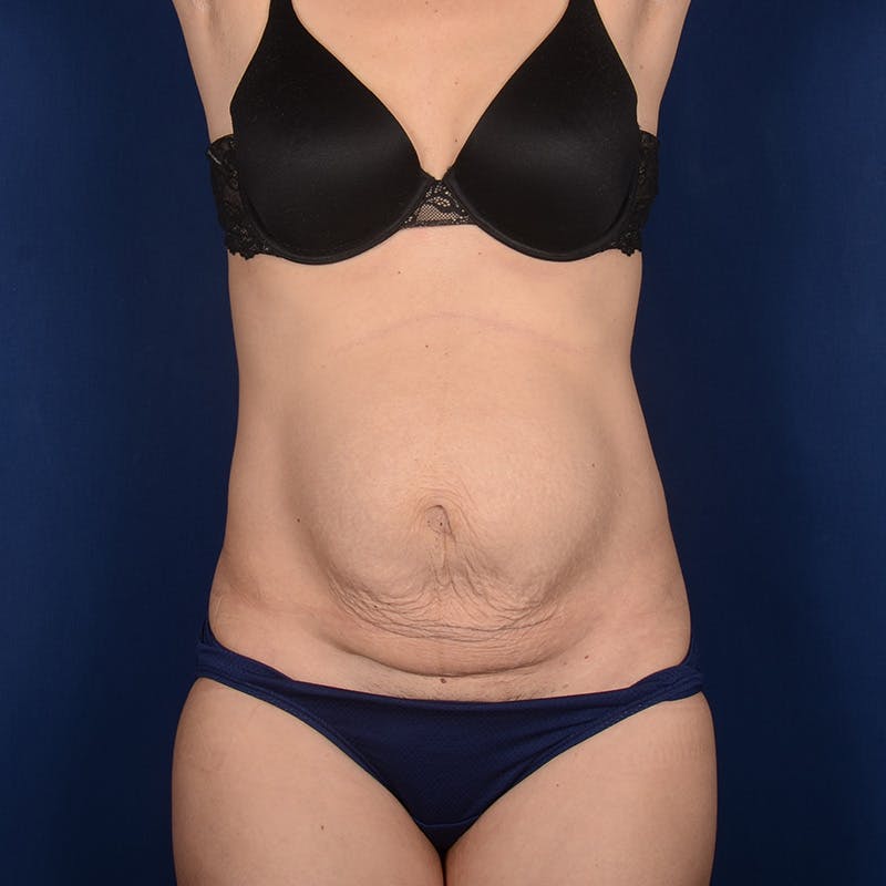 Tummy Tuck Before & After Gallery - Patient 354522 - Image 1