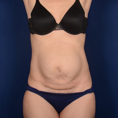 Tummy Tuck Before & After Gallery - Patient 354522 - Image 1