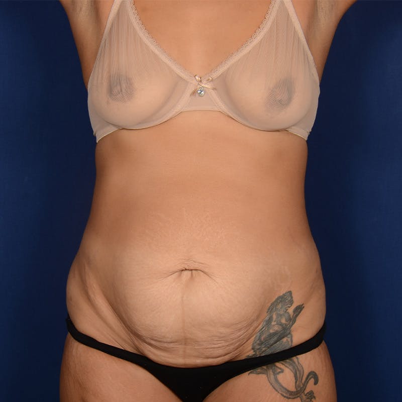 Tummy Tuck Before & After Gallery - Patient 409868 - Image 1