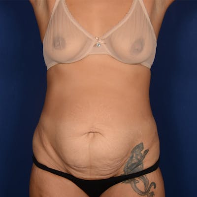 Tummy Tuck Before & After Gallery - Patient 409868 - Image 1