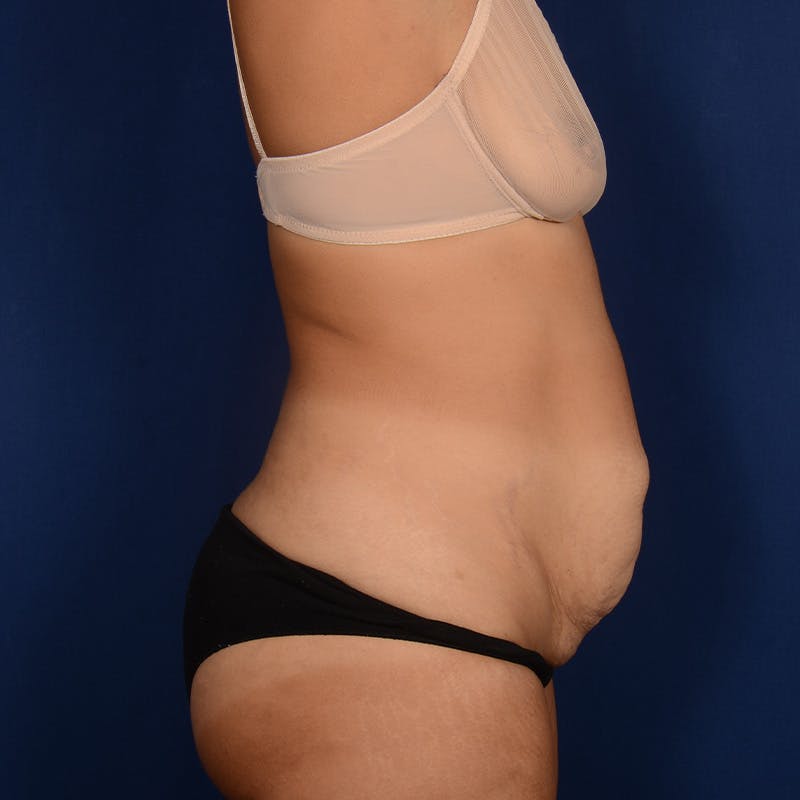 Tummy Tuck Before & After Gallery - Patient 409868 - Image 5