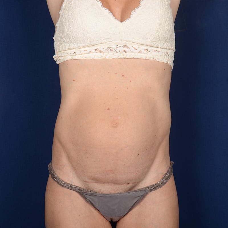 Tummy Tuck Before & After Gallery - Patient 359270 - Image 1