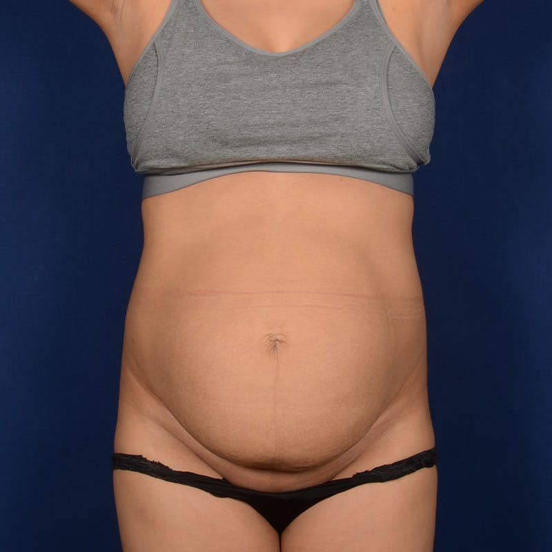 Tummy Tuck Before & After Gallery - Patient 875671 - Image 1
