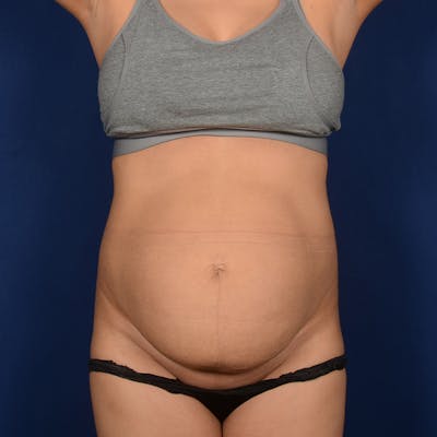Tummy Tuck Before & After Gallery - Patient 875671 - Image 1