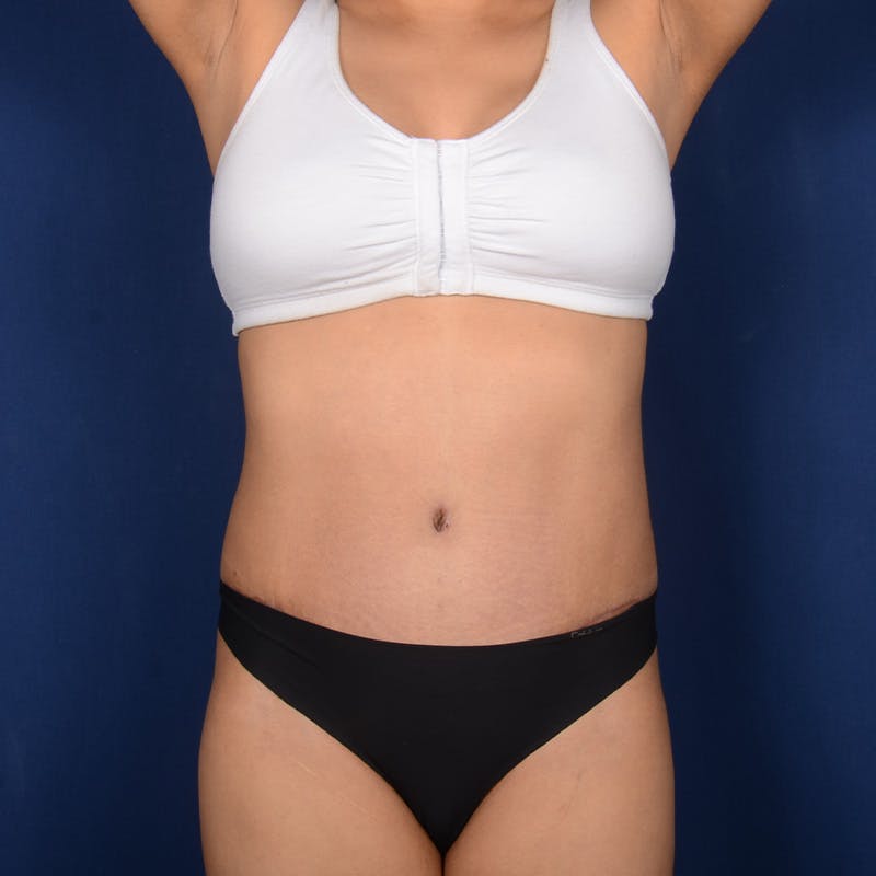 Tummy Tuck Before & After Gallery - Patient 875671 - Image 2