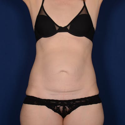 Tummy Tuck Before & After Gallery - Patient 295379 - Image 1