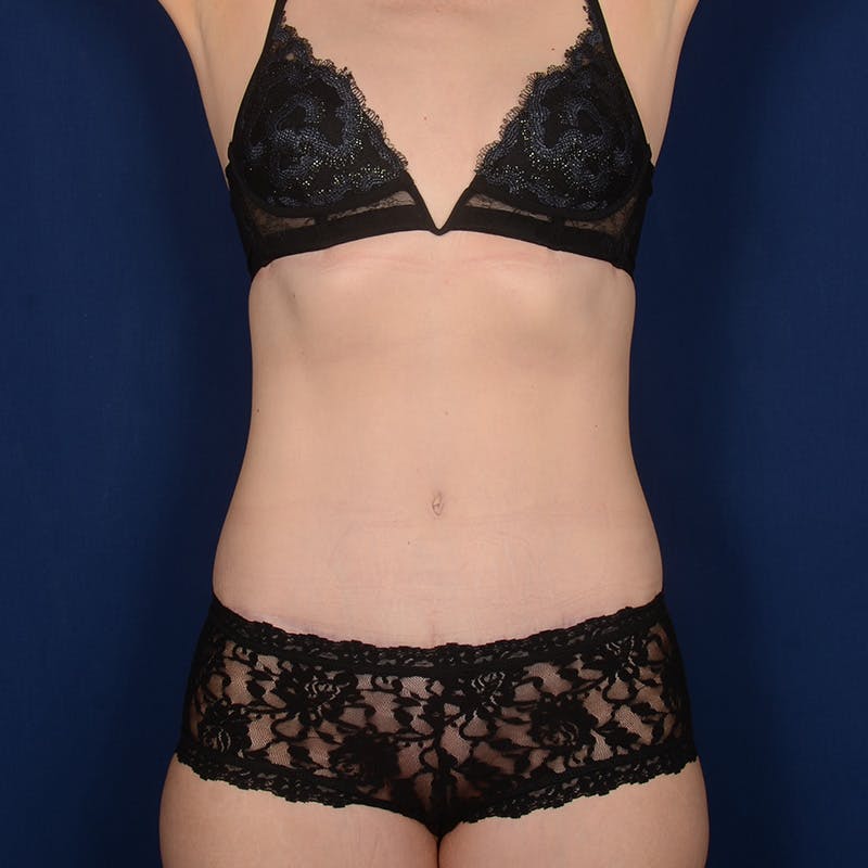 Tummy Tuck Before & After Gallery - Patient 295379 - Image 2