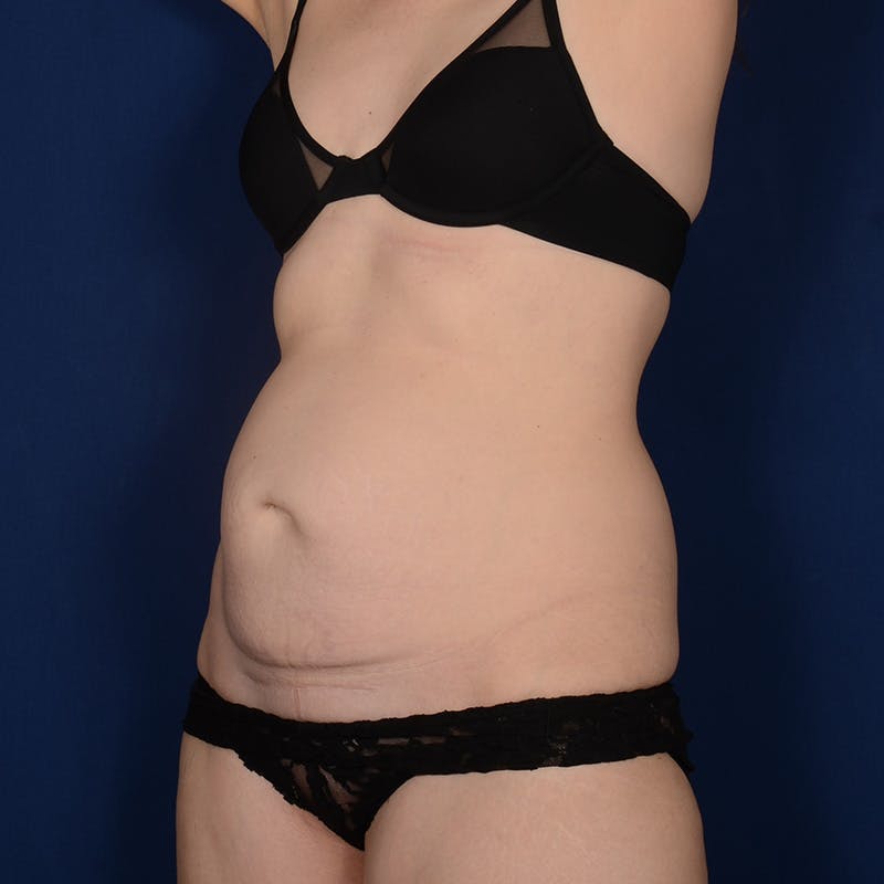 Tummy Tuck Before & After Gallery - Patient 295379 - Image 3
