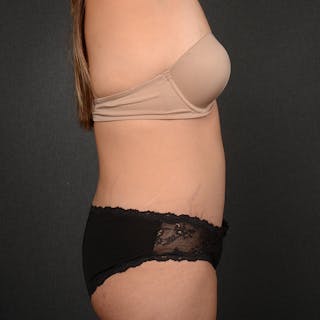 Tummy Tuck Before & After Gallery - Patient 391354 - Image 6