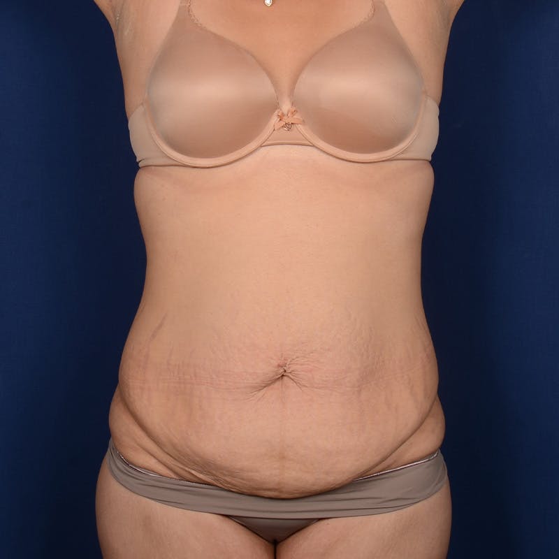 Tummy Tuck Before & After Gallery - Patient 391354 - Image 1