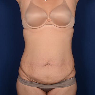 Tummy Tuck Before & After Gallery - Patient 391354 - Image 1