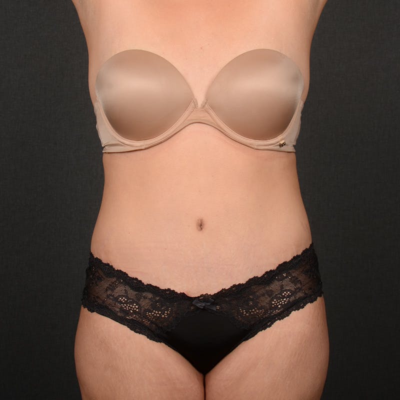 Tummy Tuck Before & After Gallery - Patient 391354 - Image 2