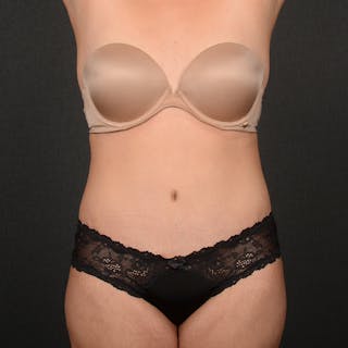 Tummy Tuck Before & After Gallery - Patient 391354 - Image 2