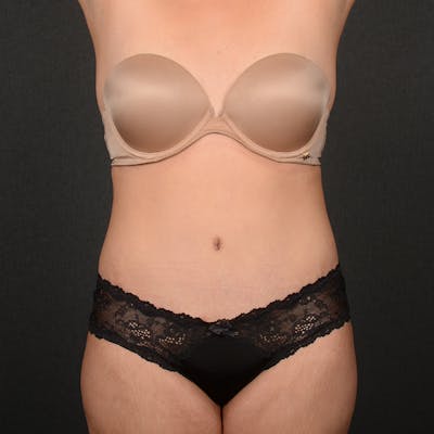 Tummy Tuck Before & After Gallery - Patient 391354 - Image 2
