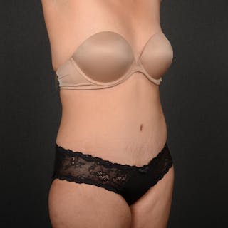 Tummy Tuck Before & After Gallery - Patient 391354 - Image 4