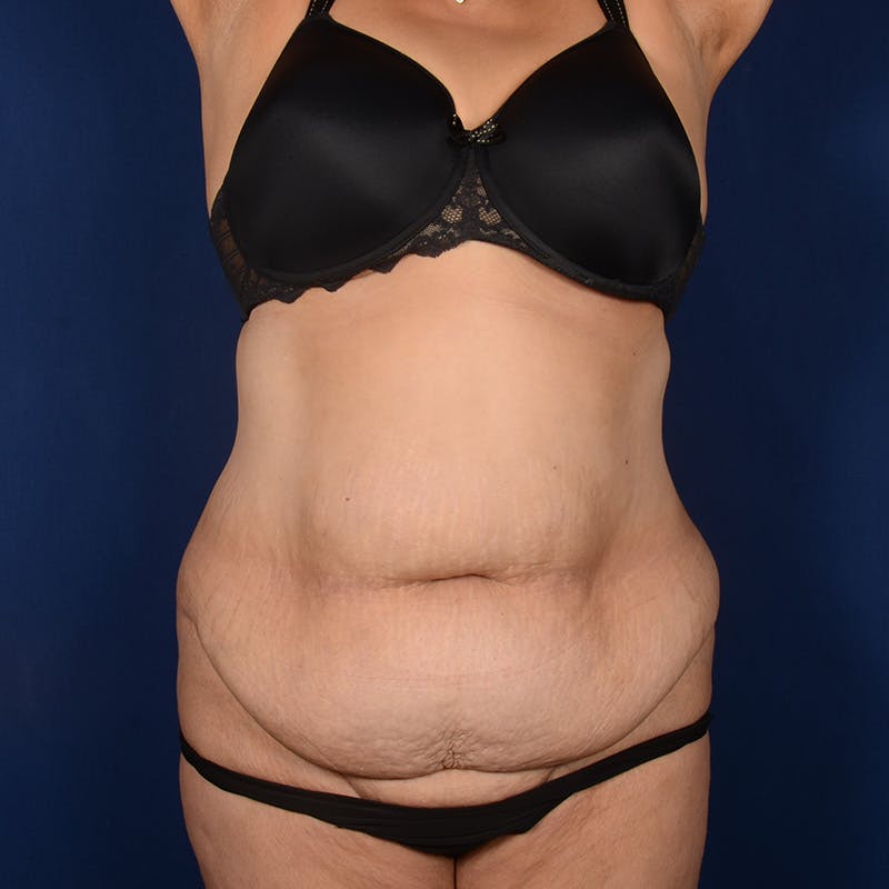 Tummy Tuck Before & After Gallery - Patient 208316 - Image 1