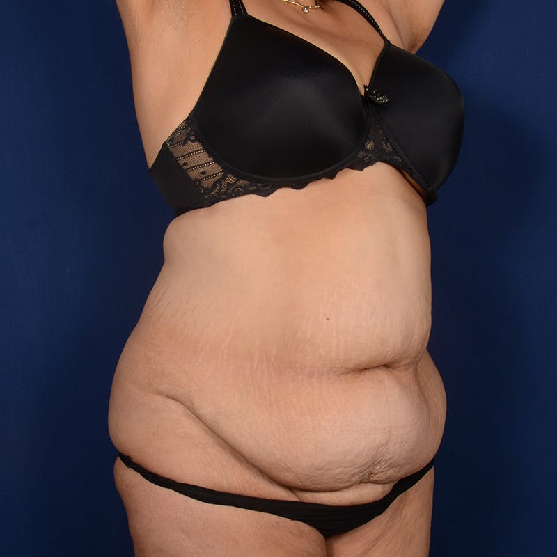Tummy Tuck Before & After Gallery - Patient 208316 - Image 3