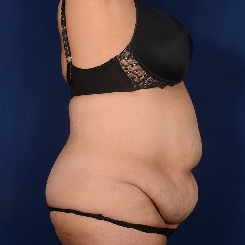 Tummy Tuck Before & After Gallery - Patient 208316 - Image 5
