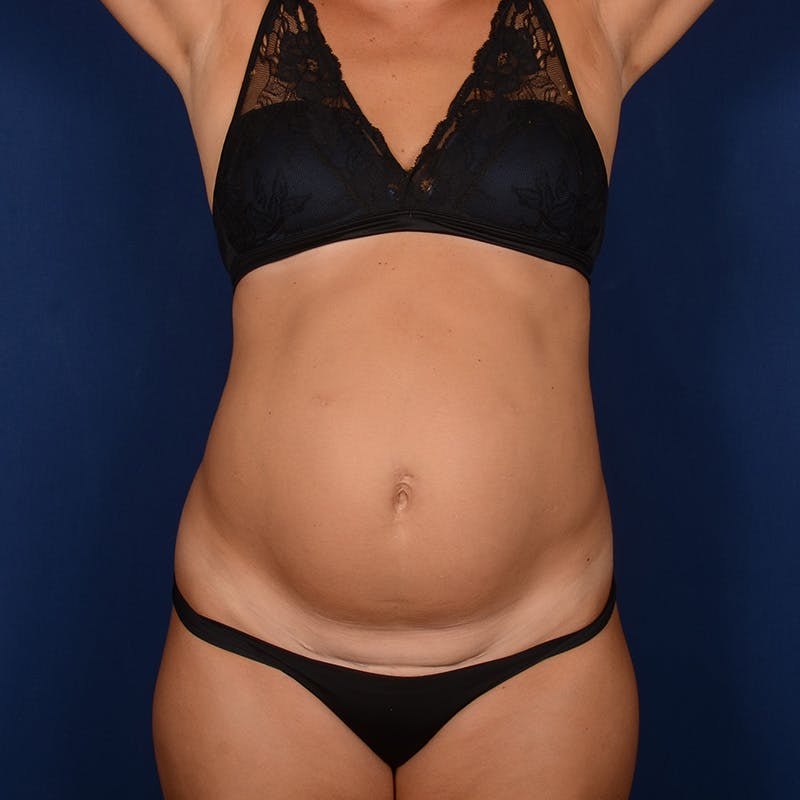 Tummy Tuck Before & After Gallery - Patient 373095 - Image 1