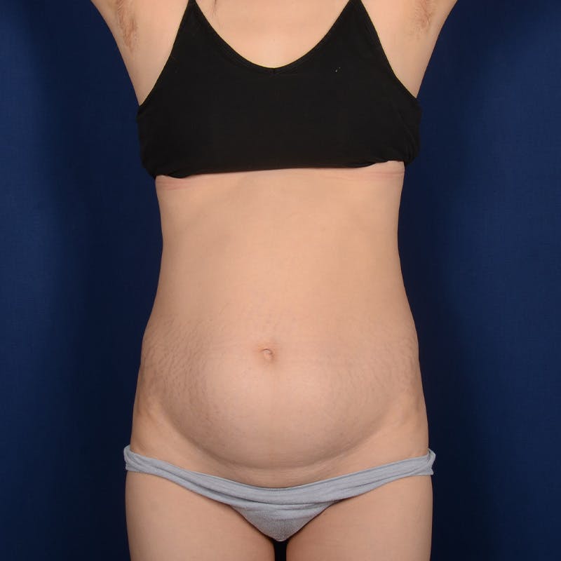 Tummy Tuck Before & After Gallery - Patient 380853 - Image 1