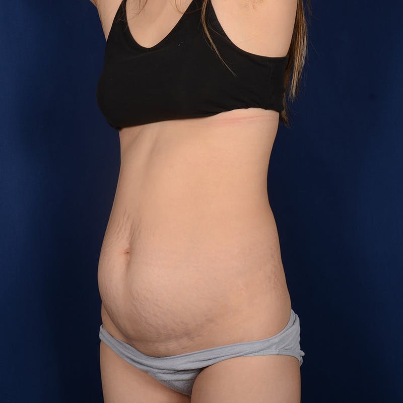 Tummy Tuck Before & After Gallery - Patient 380853 - Image 3