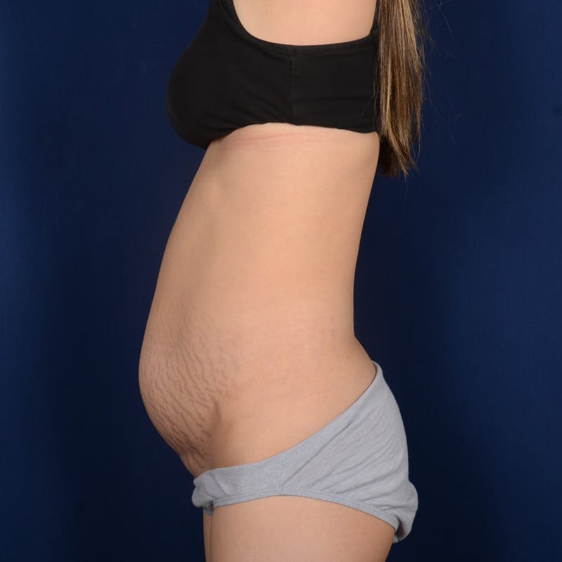 Tummy Tuck Before & After Gallery - Patient 380853 - Image 5
