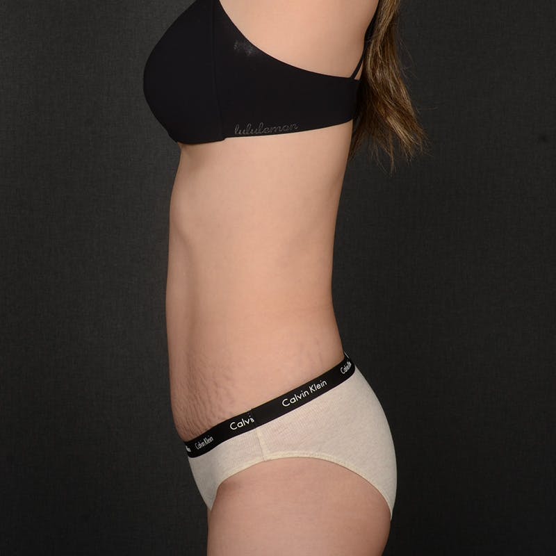 Tummy Tuck Before & After Gallery - Patient 380853 - Image 6