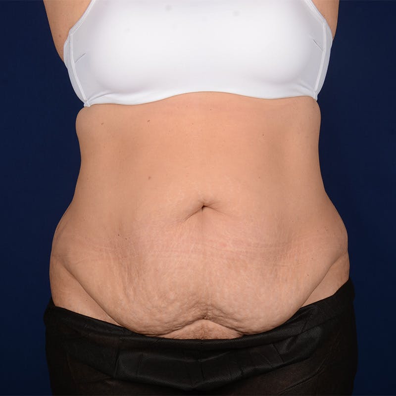 Tummy Tuck Before & After Gallery - Patient 153225 - Image 1