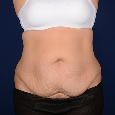 Tummy Tuck Before & After Gallery - Patient 153225 - Image 1