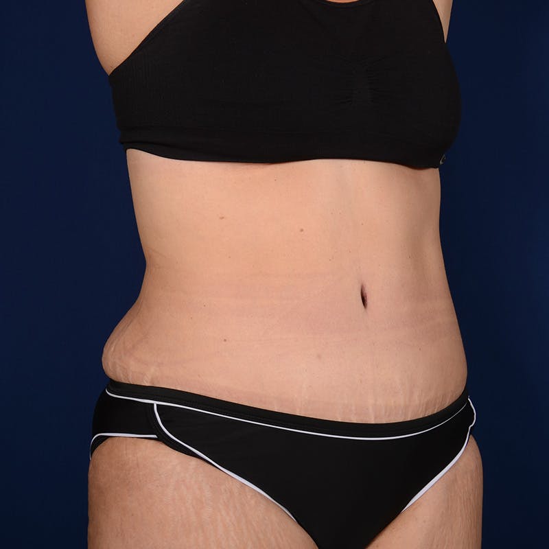 Tummy Tuck Before & After Gallery - Patient 153225 - Image 4