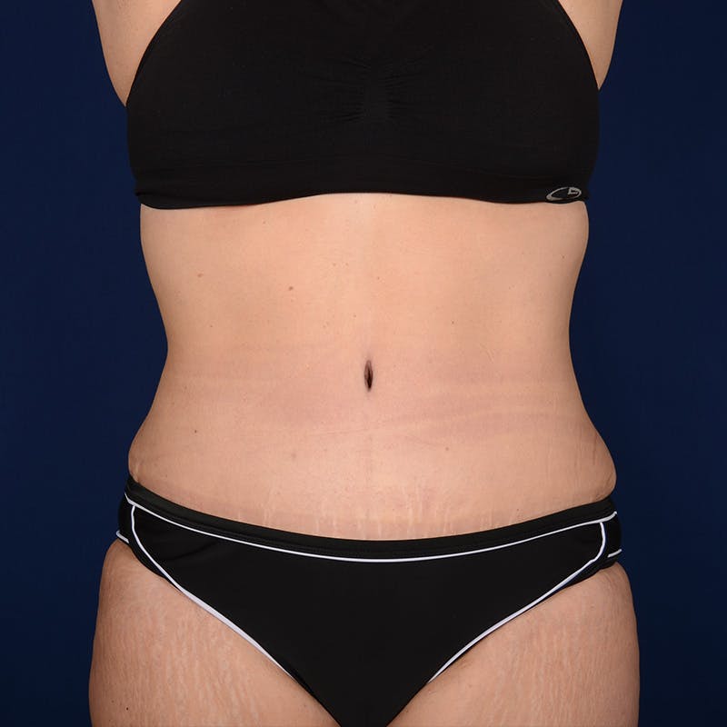Tummy Tuck Before & After Gallery - Patient 153225 - Image 2