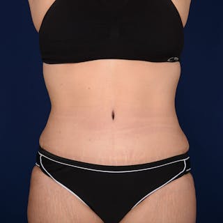 Tummy Tuck Before & After Gallery - Patient 153225 - Image 2