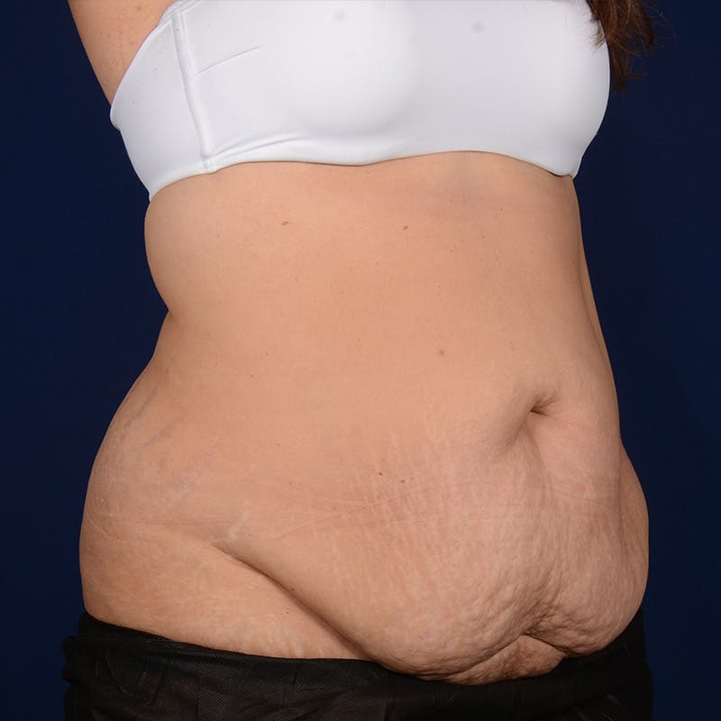 Tummy Tuck Before & After Gallery - Patient 153225 - Image 3