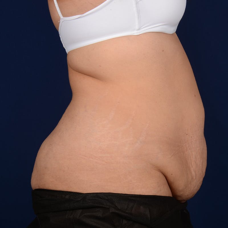 Tummy Tuck Before & After Gallery - Patient 153225 - Image 5