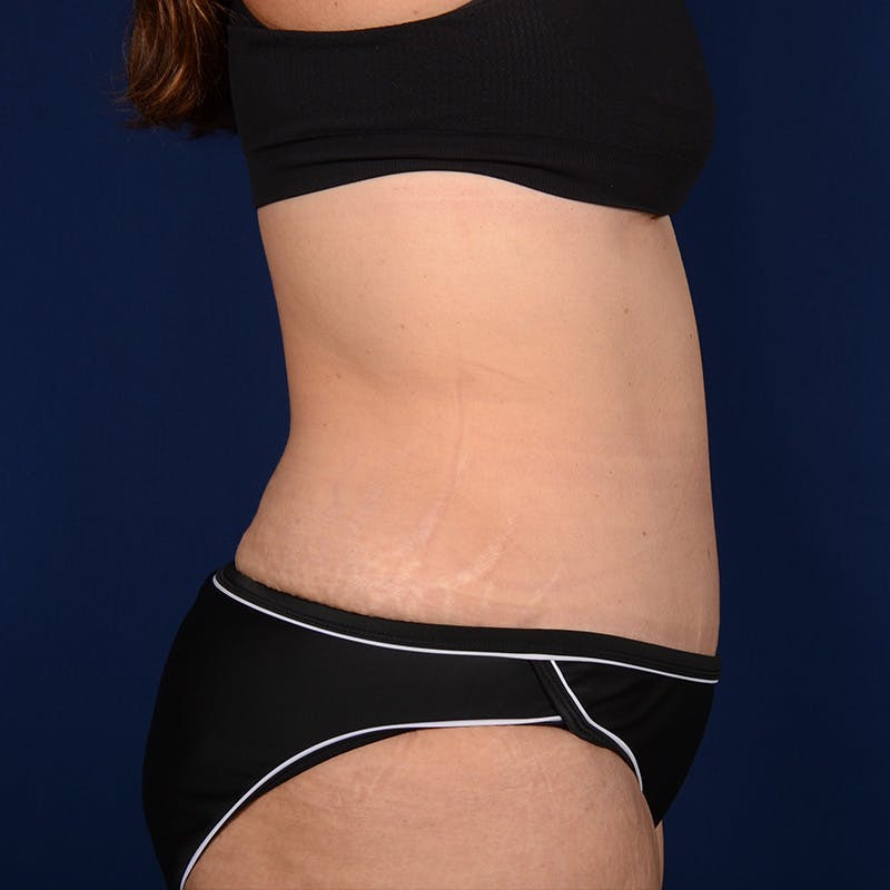 Tummy Tuck Before & After Gallery - Patient 153225 - Image 6