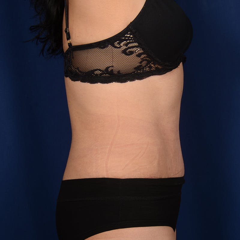 Tummy Tuck Before & After Gallery - Patient 810672 - Image 6