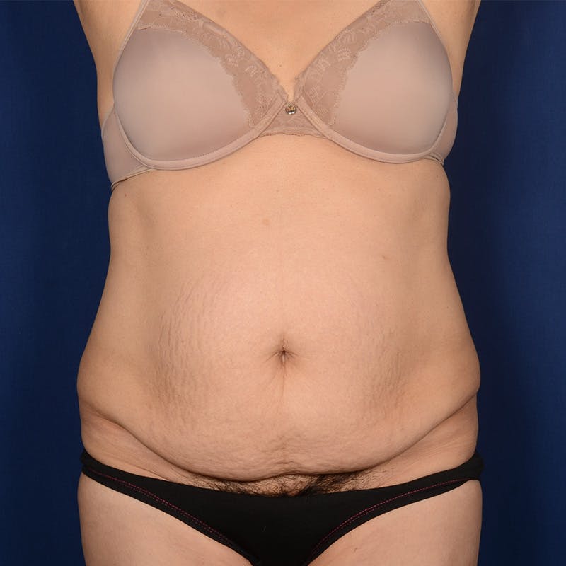Tummy Tuck Before & After Gallery - Patient 810672 - Image 1