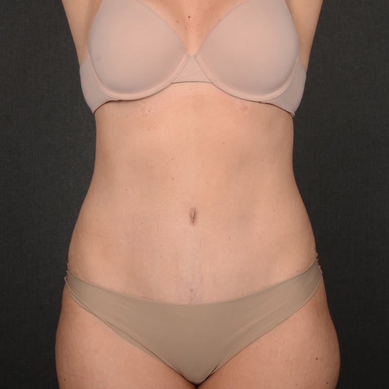 Tummy Tuck Before & After Gallery - Patient 126913 - Image 2