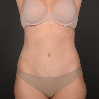 Tummy Tuck Before & After Gallery - Patient 126913 - Image 2